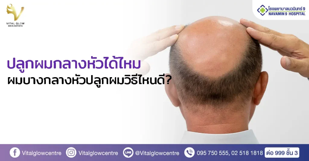 hair-transplat-bald middle-head